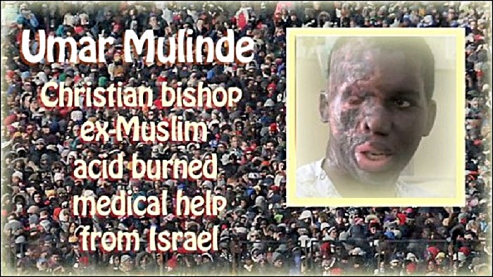 Umar Mulinde- acid burnt by Muslim & treated in Israel